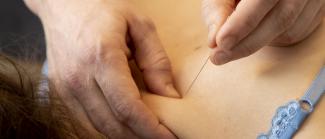 Dry Needling